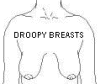 Breast Lift-Mastopexy-Breast Uplift-Indosurgery