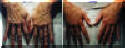 Rejuvenated Hands - Before And After