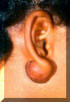 Earlobe Keloid Removal - Before And After