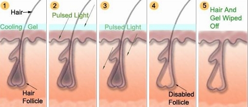 Permanent Laser Hair Removal - indosurgery.com