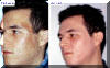 melasma - before and after lazer treatment - male