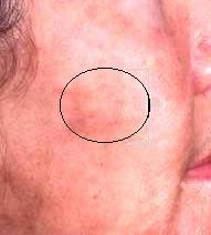 melasma - skin pigmentation