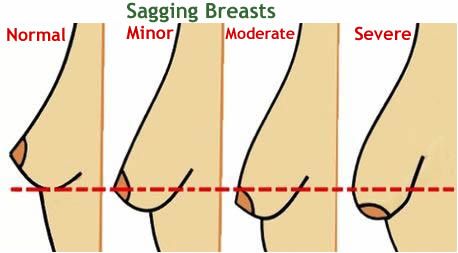 Sagging Breast Correction Surgery - Indosurgery, Mumbai, India