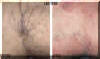 Varicose Veins Removed From Under The Knees - Before And After