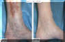 Varicose Veins Removed From Legs - Before And After