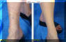 Varicose Veins Removed From Legs - Before And After