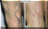 Varicose Veins Removed From Arms - Before And After