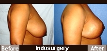 Breast-Lift-Surgery-Indosurgery