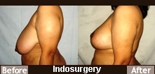 breast-uplift-surgery-indosurgery